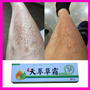 皮肤淀粉样变止氧薬膏 皮焱湿珍牛皮藓屑瘙痒鹅掌干裂感染风 3送1