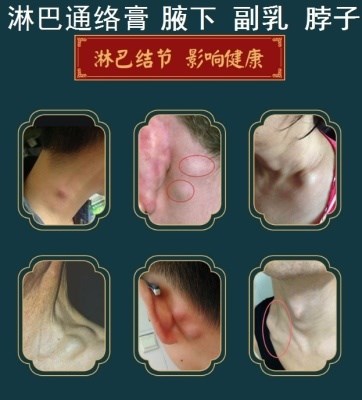 日本购淋巴散结膏结消贴排毒脖子腋下疏通肿大消颈部去副乳结节神