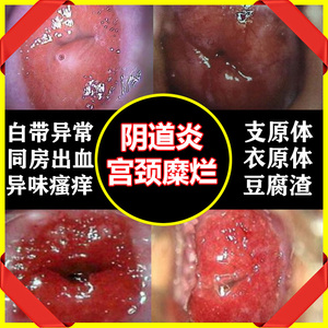 妇科炎症凝胶阴道炎霉菌性阴炎豆腐渣支原体衣原体宫颈糜烂炎药