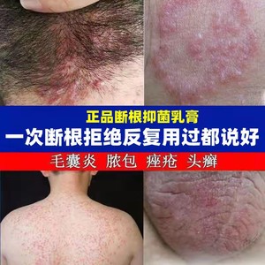 毛壤炎阴囊瘙痒去潮湿私处睾丸男女止痒膏冰霜肛门潮湿瘙痒屁眼痒