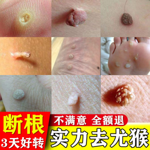去瘊子肉粒疙瘩祛疣灵脚底疣瘊净去除猴子刺猴专用药肉刺痣膏断根