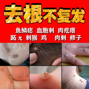 去瘊子的正品刺候灵膏除鱼鳞痣血胞刺侯修子脖肉粒跖尤根神器专用