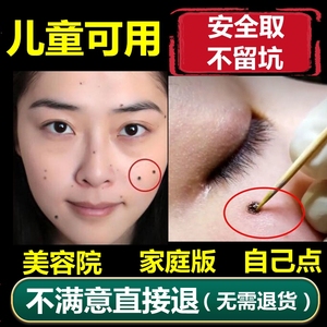 去痣点痣膏无痕正品脸部除斑点志去黑痣祛痣黑点斑水点斑水