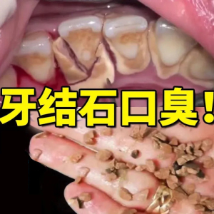 【一夜掉结石】牙结石溶解牙石速效去除牙结石专用牙膏口臭去除器