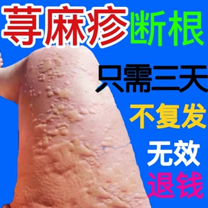 荨麻疹过敏止痒断根专用药膏治疗急慢性风团皮肤瘙痒寻麻疹抑菌药
