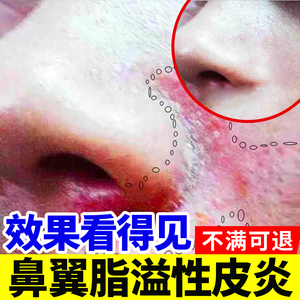 脂溢性皮炎鼻翼溢脂性鼻子两侧发红脱皮干燥起皮脸部两边泛红霜EW