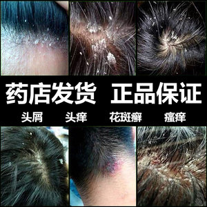 去屑膏头酮康挫痤铜洗发液硐洗头水的洗液药物药用医用洗24人付款16