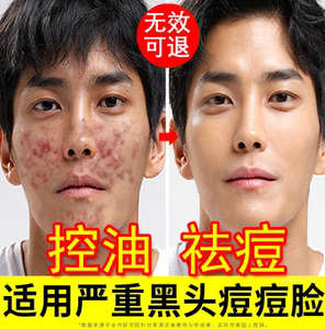 痤疮去除螨虫洗面奶面部深层清洁黑头脸控油祛痘男士专用女学生款