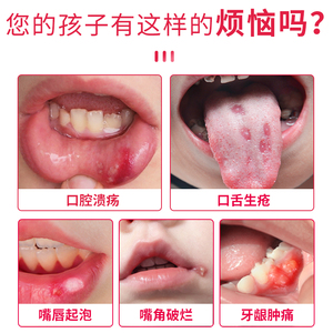 儿童口腔溃疡喷雾剂复发性口疮贴舌头西瓜霜宝宝小孩儿凝胶的神药