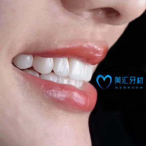 牙贴片超薄