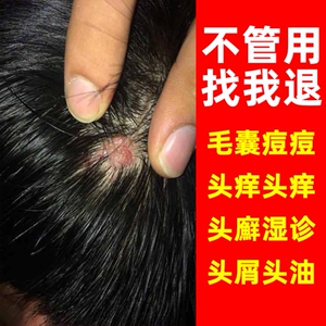 毛囊炎专用药头皮藓药特效中医瘙痒膏药真菌治疗去痒儿童头藓正品