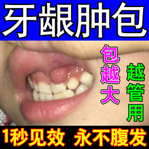 牙龈肿包消脓鼓包牙疼消焱牙龈t肿痛止疼药速效保护剂瘘管上火出