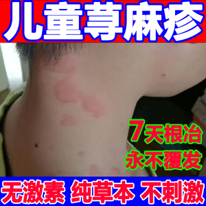 丘疹性荨麻疹儿童