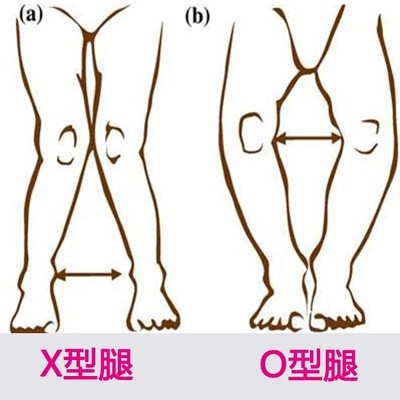 xo型腿 解剖图图片