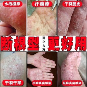 脱皮干裂药膏手气膏手痒手癣真菌感染鹅掌风皮炎瘙痒顽固小水泡