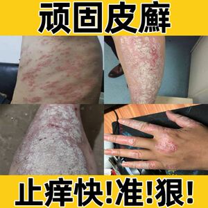 去鸡皮肤的药膏