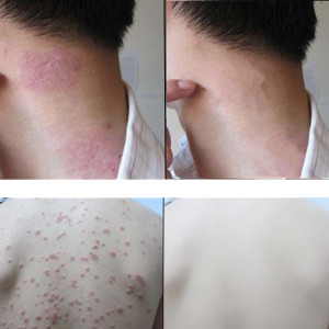 下面男女小红两侧裆部潮湿下体大毛毛皮肤红点大腿蛋蛋痒阴囊屁眼