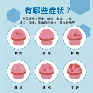 珍珠克男士龟头有炎包皮阴g茎疹红点红肿斑糜烂疱瘙痒冠状沟炎