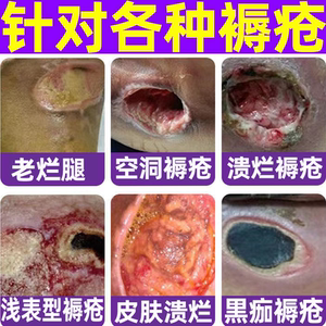 褥疮膏去腐生肌膏
