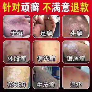 牛皮藓正品杀菌去癣药膏治皮肤瘙痒外用皮廯药止痒抑菌膏紫椒癣酊