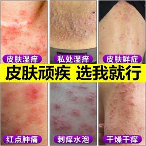 维a乳酸膏季德胜蛇膏东润荣氏膏抑菌汉方抑菌凤仙狼毒清足康正品