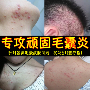 治疗毛囊炎药膏头皮癣脂溢性皮肤头部疙瘩脓疮前后胸背手臂腿专用