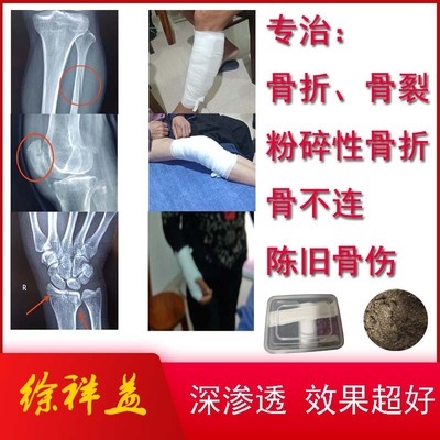 粉碎性骨折接骨膏