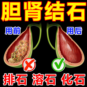 德国强力消石素消石药消除肾脏胆囊肝肾结石排石排胆结溶石2人付款