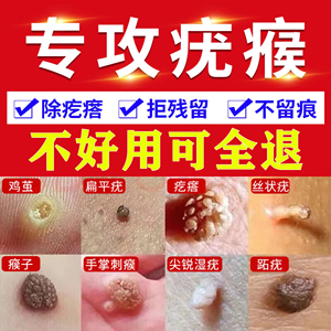 去猴子肉粒疙瘩祛瘊子鱼鳞痣疣药治手脚上肉刺专用膏刺猴去除正品