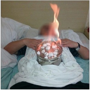 巨罐火罐升阳吸湿