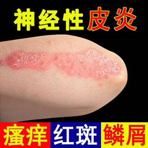 神经性皮炎膏无激素