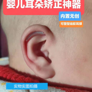 婴儿耳朵矫正器新生儿耳招风耳定型器耳轮廓塑形内置支架牵引器