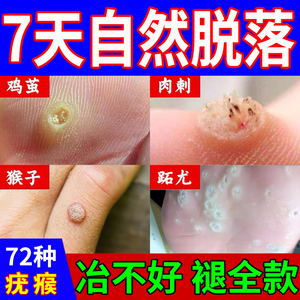00tb4594000465淘宝去肉刺瘊子猴子肉粒疙瘩鱼鳞痣药颈部丝疣立净