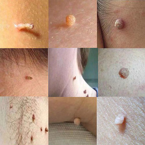 去除身上小肉粒丝状疣清疣祛疙瘩子瘊猴子黑痣腋窝肉粒疙瘩专用膏