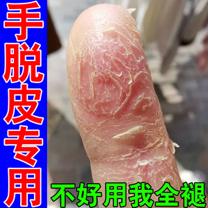 手脱皮药膏真菌感染手指头爆皮痒手上起皮干燥脱皮季节性干裂发痒