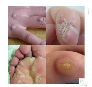 鸡眼跖疣膏去除老茧脚垫脚疔肉刺手足茧日本无痛清茧去尤灵除尤净