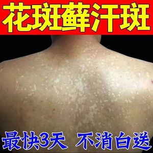 汗斑露喷剂