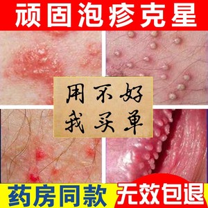 治生殖器疱疹断根防复发神器男女性私处病毒根除克星带状外用药膏