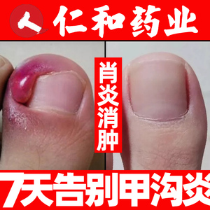 甲沟炎治疗专用药膏软甲消肿去肉芽消炎软膏息肉特效去除液膏正品