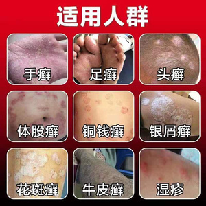 牛皮t癣断根李氏百草治疗外用药治头癣药膏银屑病手足脚藓鲜止痒