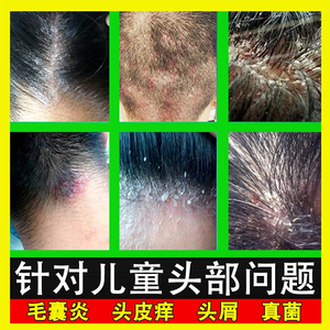 宝宝头皮癣