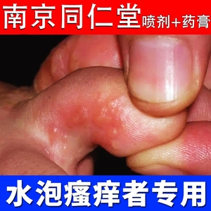 脚气水泡型脚气药膏同仁堂喷雾喷剂专用脚汗香港脚神器祛脚气药水