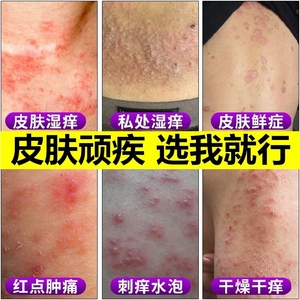 除湿止痒软膏维a乳酸膏皮肤醋酸去炎松尿素软膏瘙痒止痒去根