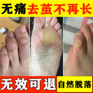 祛鸡眼膏去除脚上长老茧手上胼胝膏根脚垫脚底脚趾关节茧子软化剂