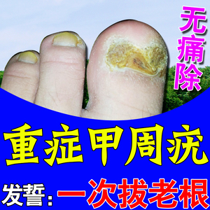 甲周疣专用药膏治甲下疣跖疣脚指甲发厚变黄去除疣肉刺瘊子神器