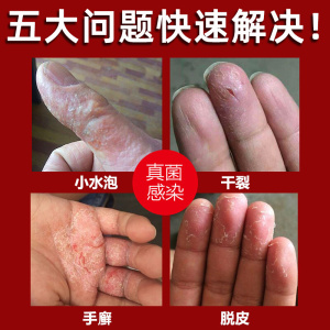 鹅掌风干裂脱r皮小水泡股癣手癣真菌感染止痒手气膏外用顽固手痒