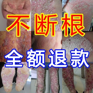 苗医治疗丹毒软膏光泽苔藓药膏百草止痒膏正品肤干燥瘙痒全身外用