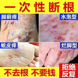 烂脚丫药膏贵州苗家药膏独家草本药膏水泡手足苗家偏方药膏脚气鲜