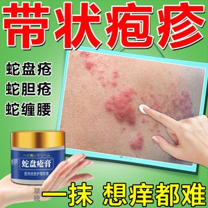 蛇盘疮后遗症神经疼外用药膏带状疱疹水痘蛇胆疮蛇缠腰止痒痛喷剂