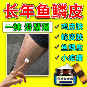 鱼鳞病皮肤霜药膏克星去蛇皮肤鱼鳞腿部小腿全身皮肤干燥鸡皮疙瘩